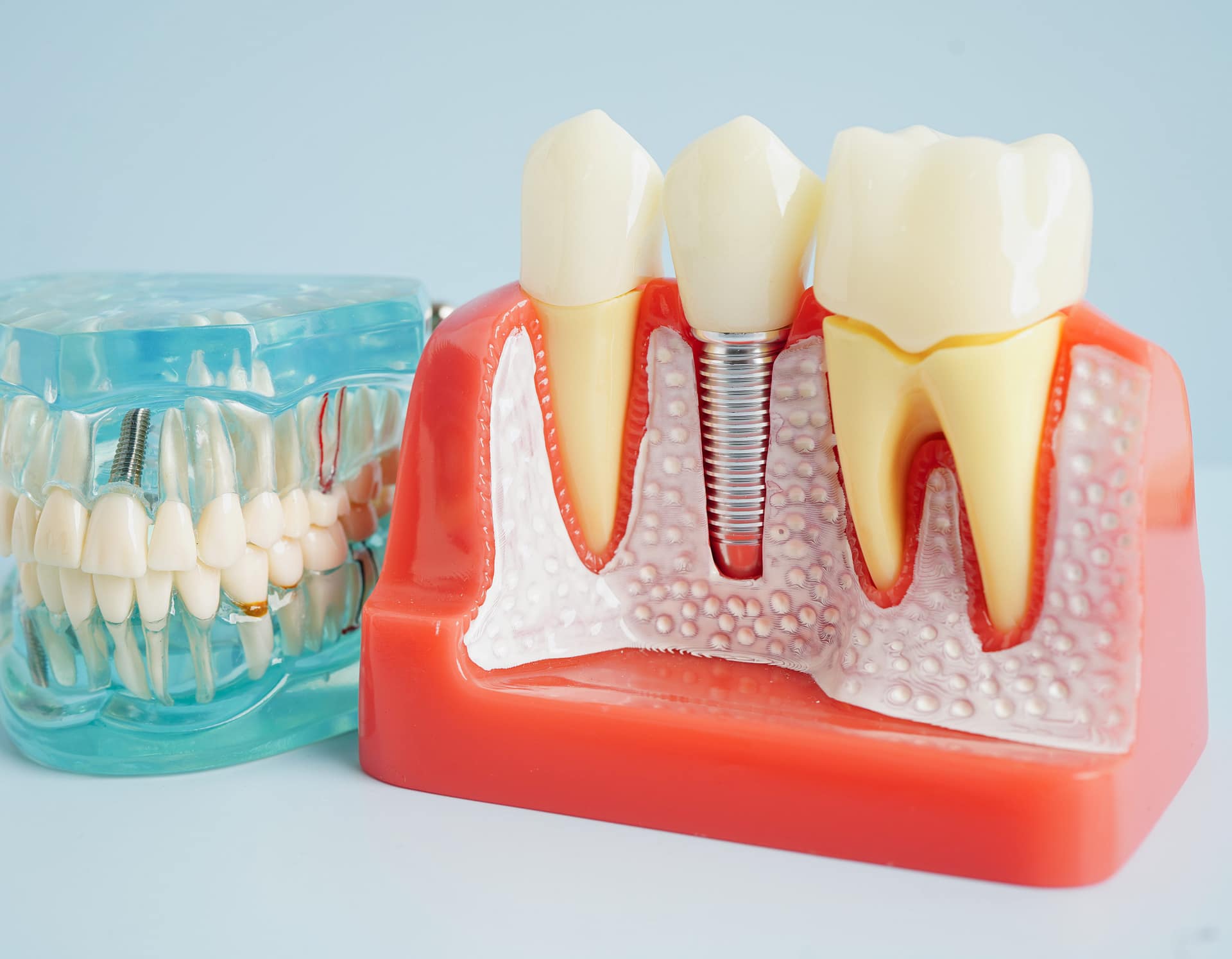 Single Dental Implant