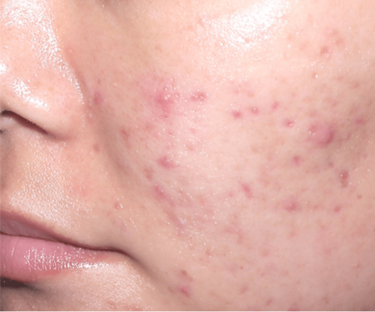Close-up of active acne and redness on the cheek