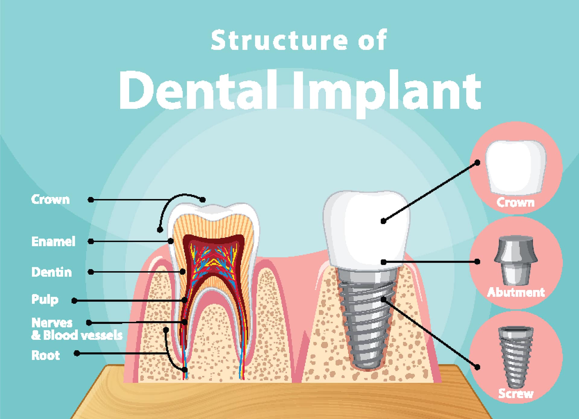 Structure of Dental Implant
