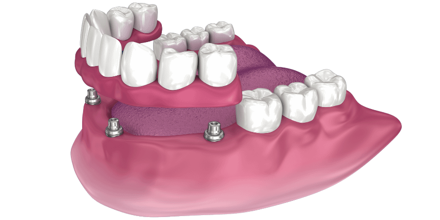 3D model of a full arch denture supported by multiple dental implants